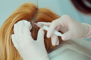 Инъекции плазмы в волосистую часть головы